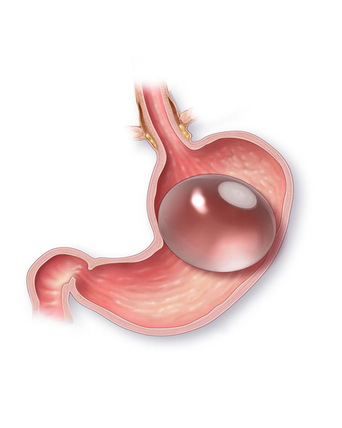 Gastric Balloon