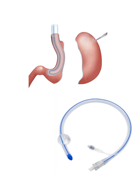 Gastric Calibration Tube 